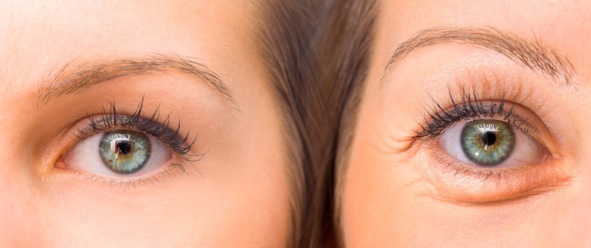 Cirugía de Párpados (Blefaroplastia)