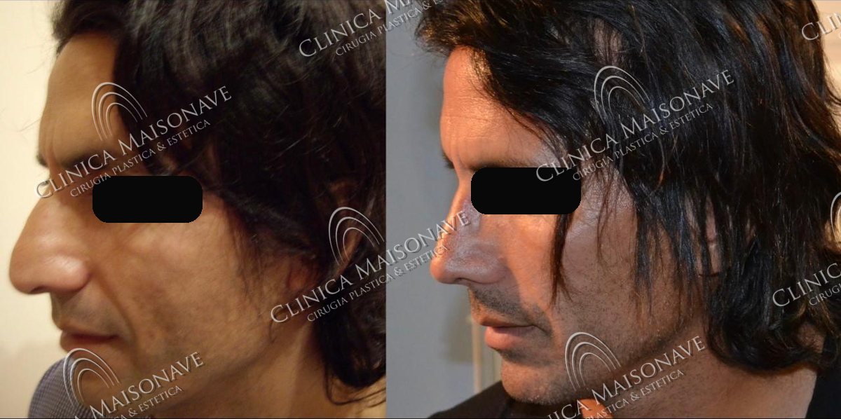 Resultado real, antes y después, Clínica Maisonave