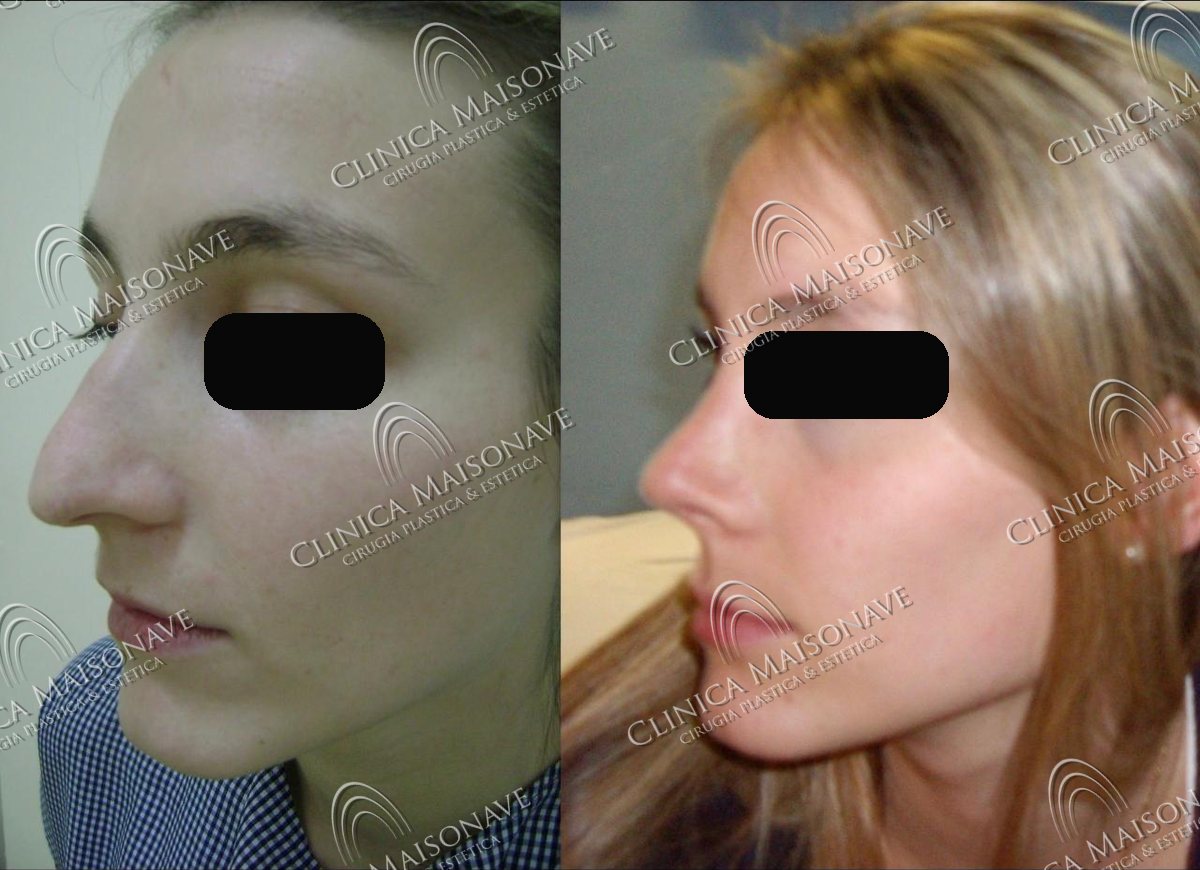Resultado real, antes y después, Clínica Maisonave