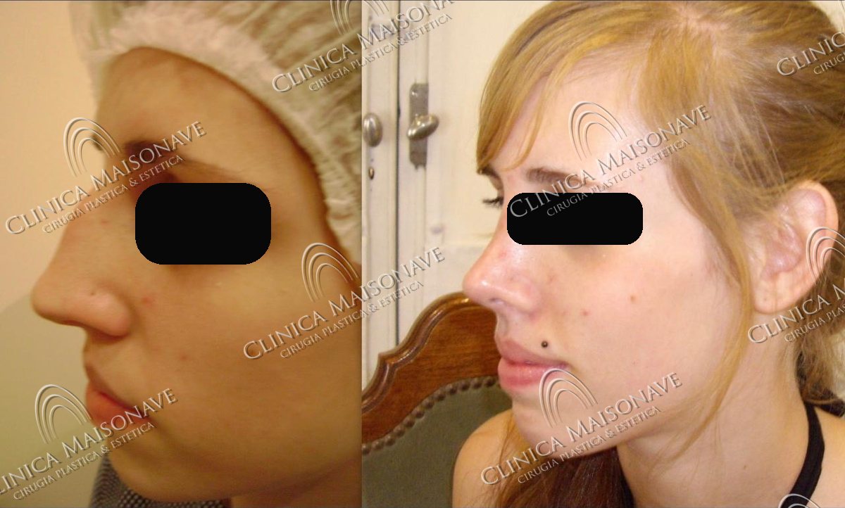Resultado real, antes y después, Clínica Maisonave