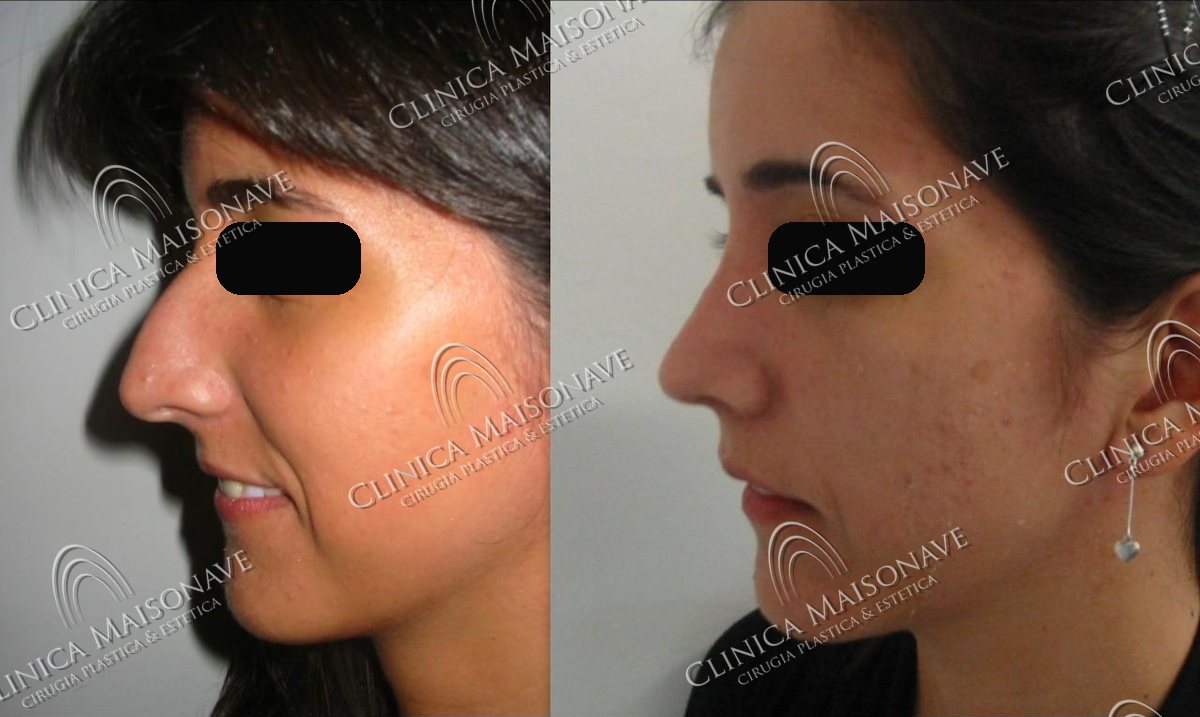 Resultado real, antes y después, Clínica Maisonave