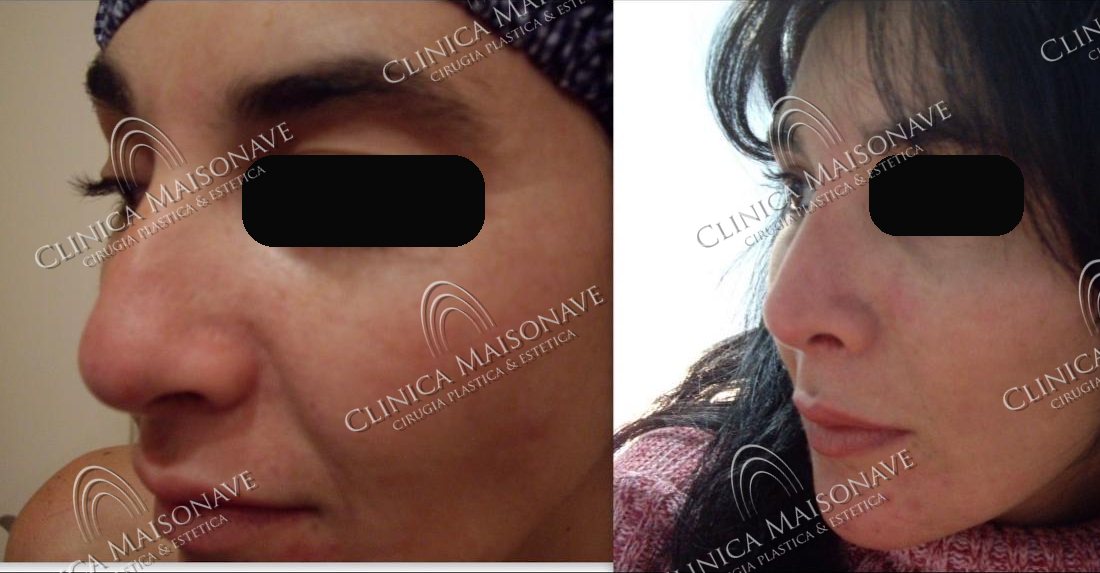 Resultado real, antes y después, Clínica Maisonave
