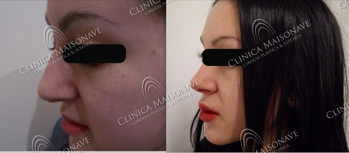 Resultado real, antes y después, Clínica Maisonave