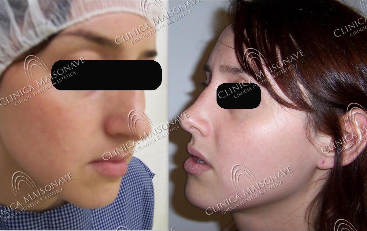Resultado real, antes y después, Clínica Maisonave
