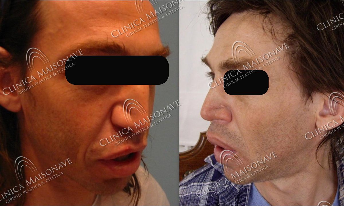 Resultado real, antes y después, Clínica Maisonave