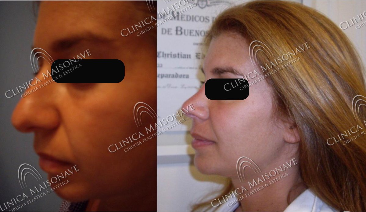 Resultado real, antes y después, Clínica Maisonave
