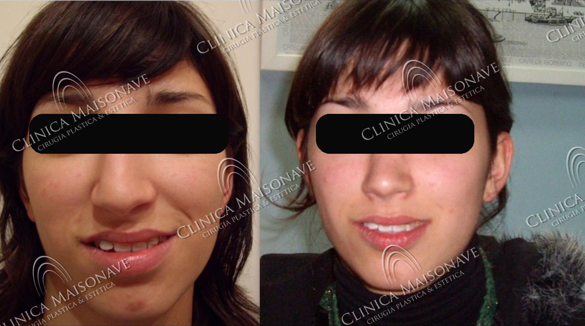 Resultado real, antes y después, Clínica Maisonave