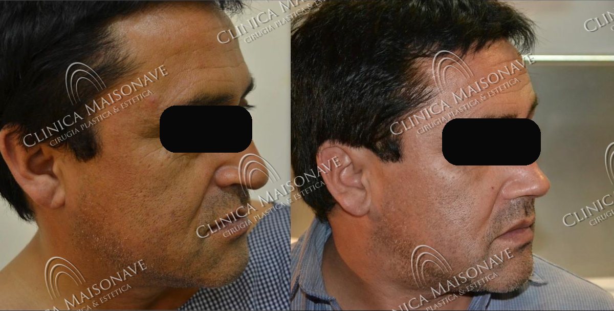 Resultado real, antes y después, Clínica Maisonave