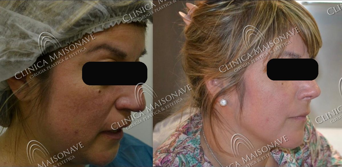 Resultado real, antes y después, Clínica Maisonave