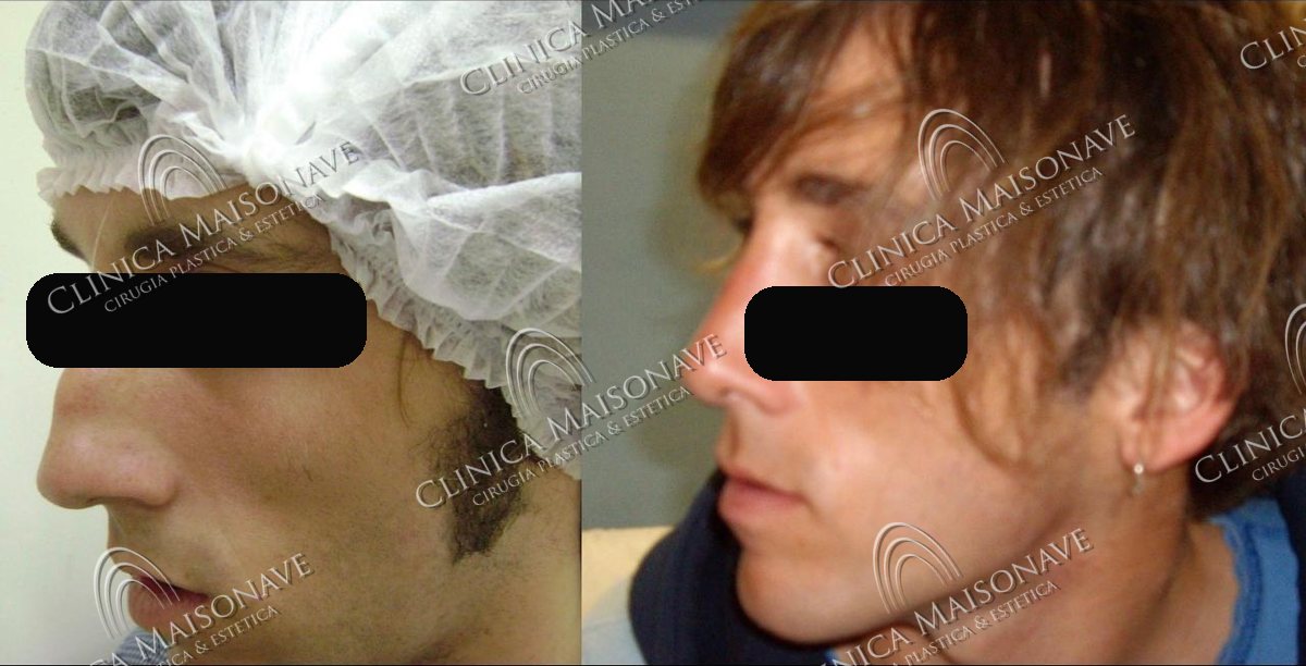 Resultado real, antes y después, Clínica Maisonave