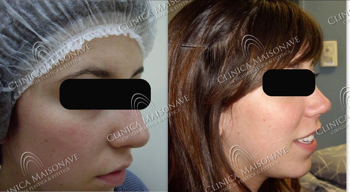 Resultado real, antes y después, Clínica Maisonave