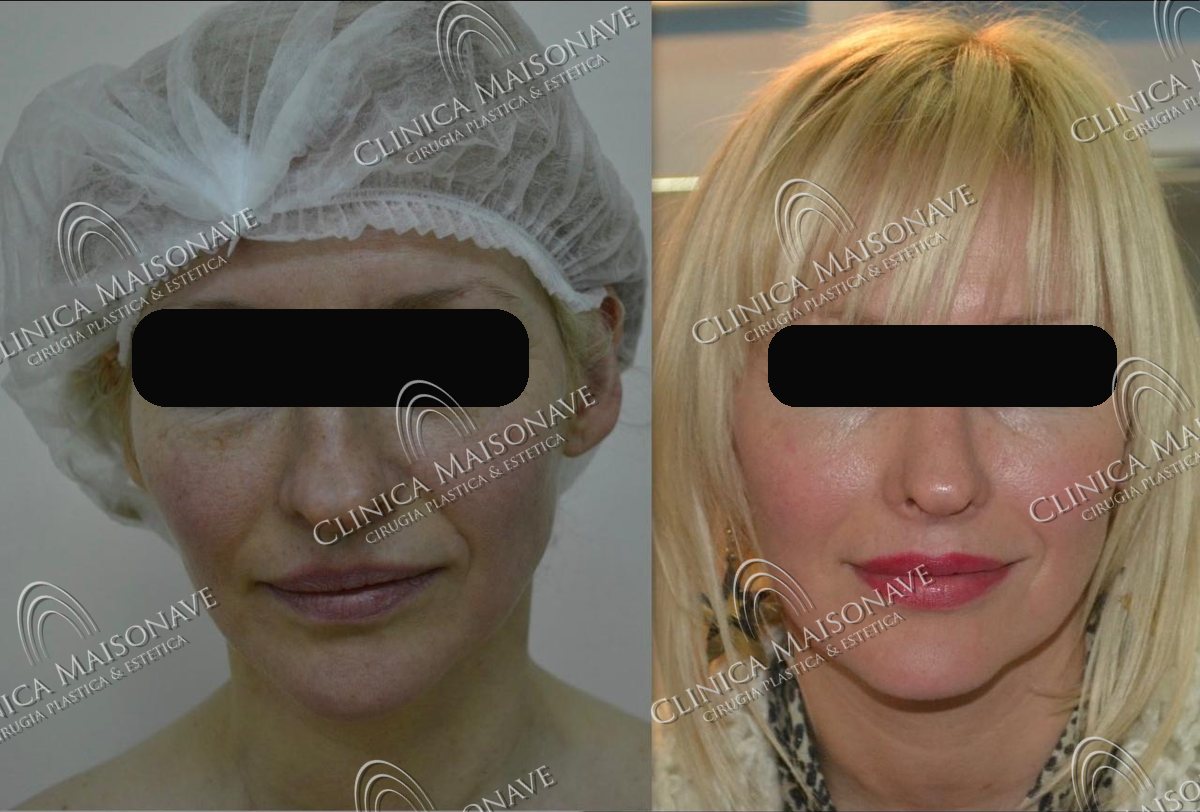 Resultado real, antes y después, Clínica Maisonave