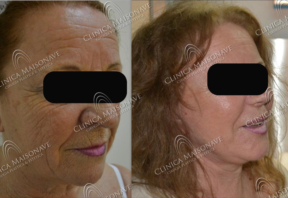 Resultado real, antes y después, Clínica Maisonave