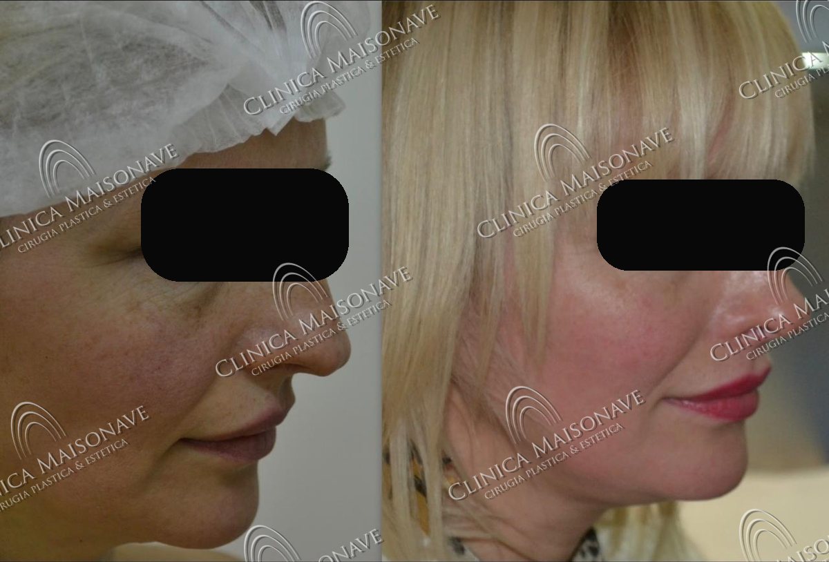 Resultado real, antes y después, Clínica Maisonave