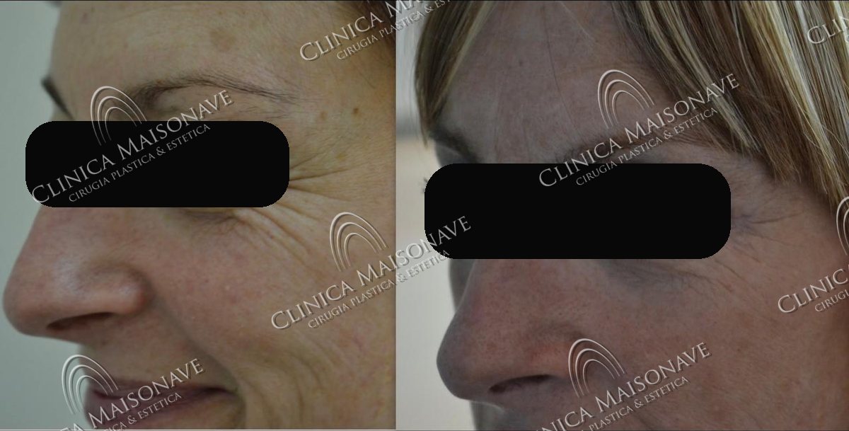 Resultado real, antes y después, Clínica Maisonave
