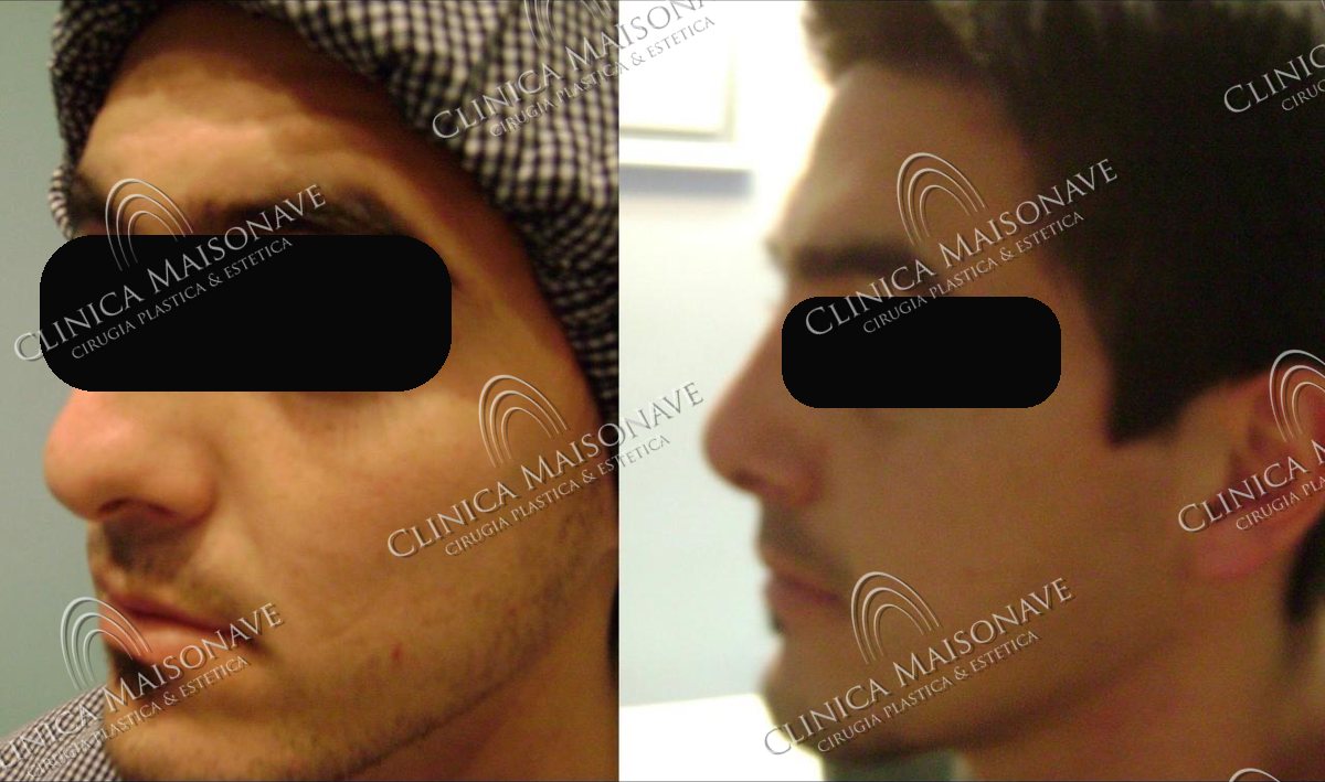Resultado real, antes y después, Clínica Maisonave