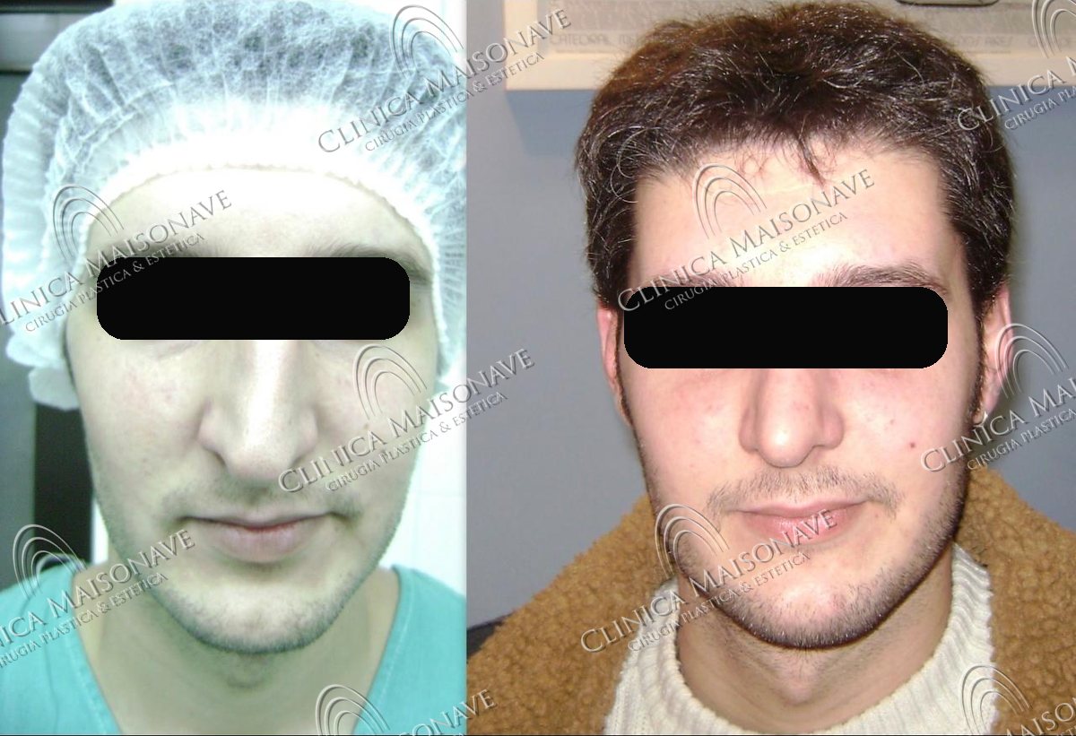 Resultado real, antes y después, Clínica Maisonave