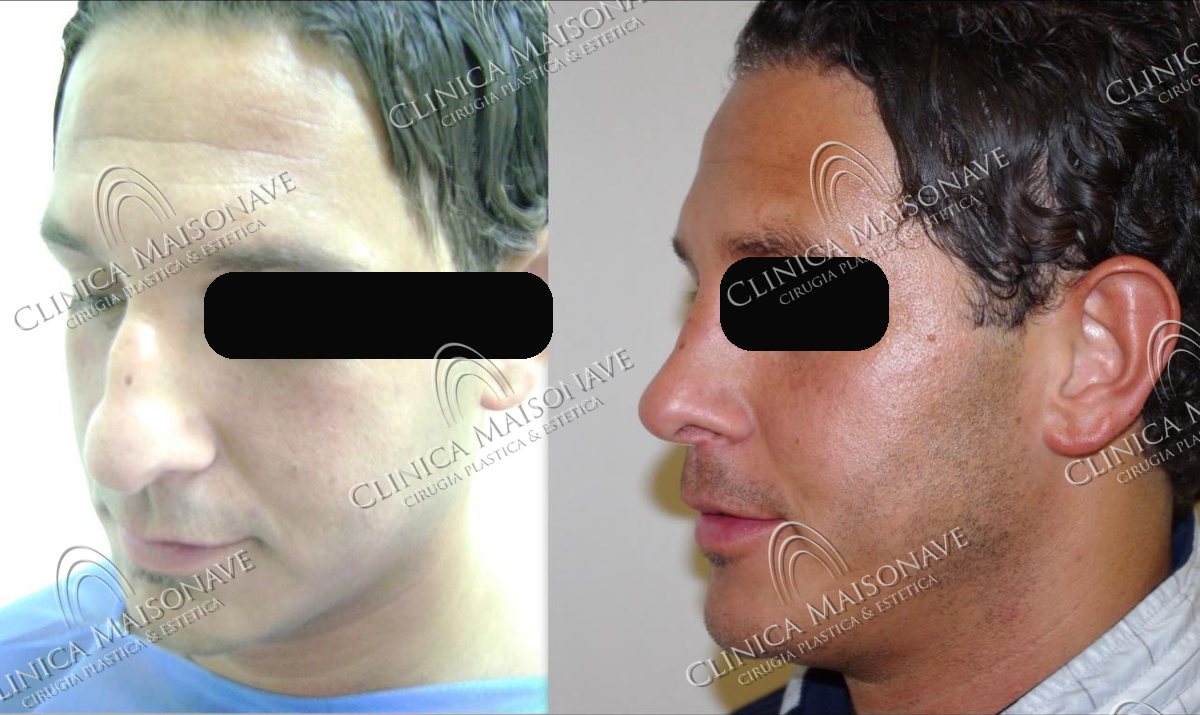 Resultado real, antes y después, Clínica Maisonave