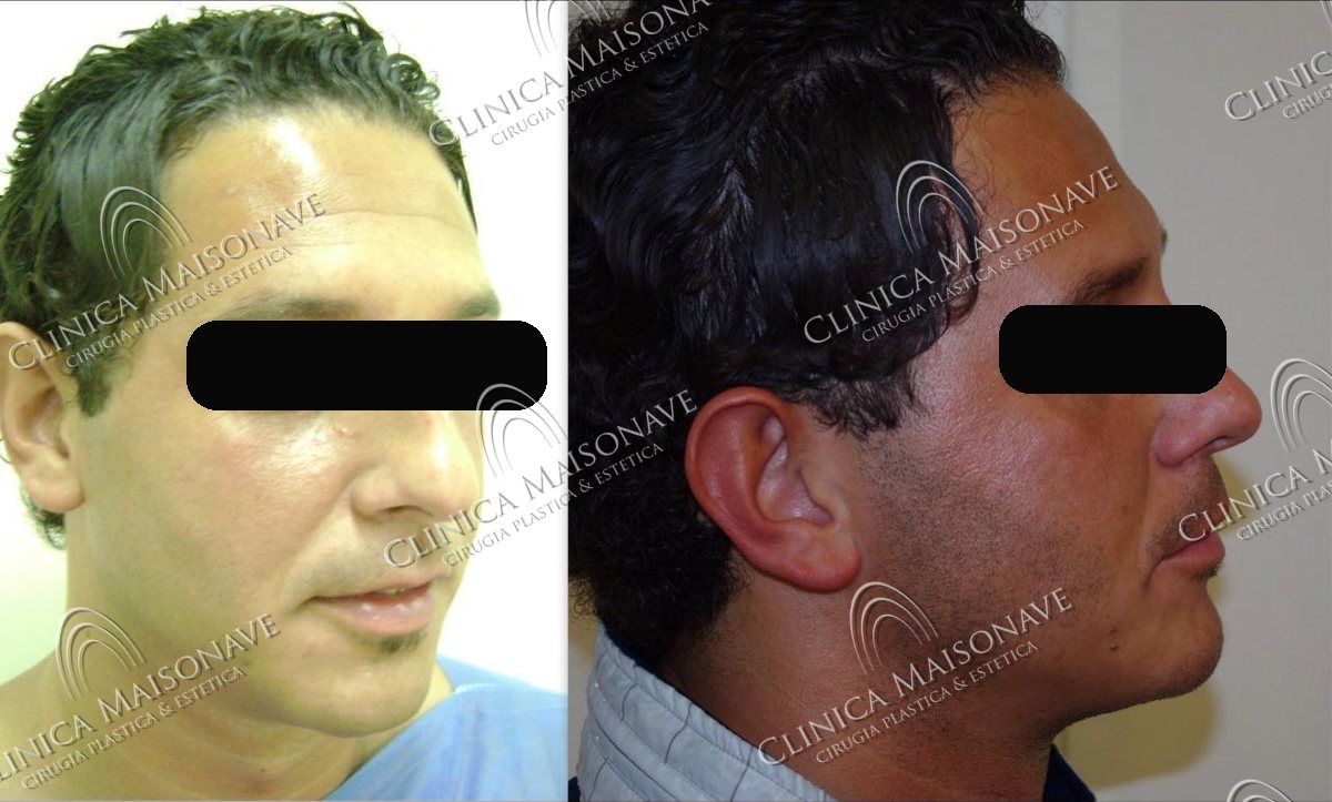Resultado real, antes y después, Clínica Maisonave
