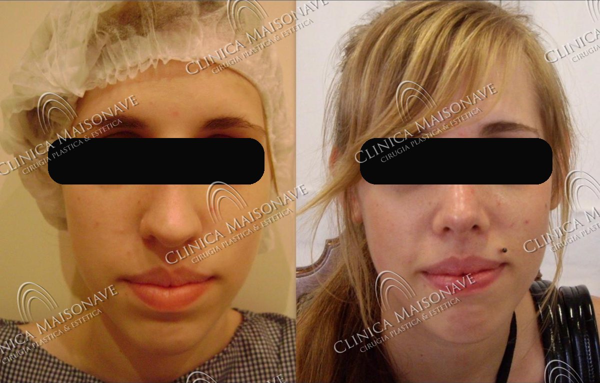 Resultado real, antes y después, Clínica Maisonave