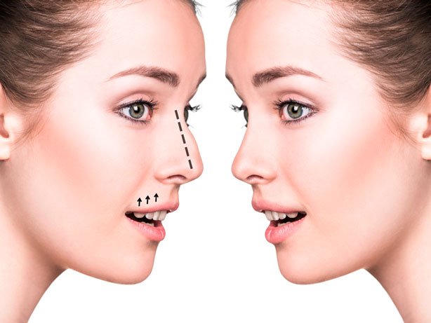 Rinoplastia (Cirugía de Nariz)